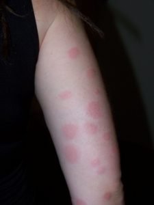 Allergie punaise de lit