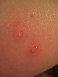 punaise de lit allergies