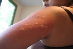 Reconnaître les allergies aux punaises de lit